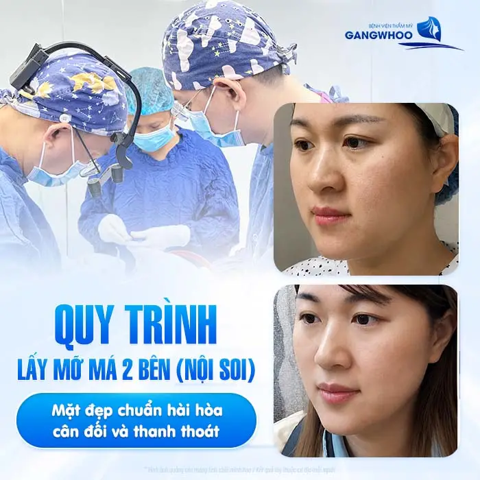 Quy trình lấy mỡ má 2 bên (nội soi) mặt đẹp chuẩn hài hòa, cân đối và thanh thoát