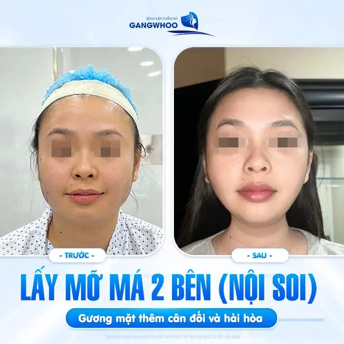 Lấy mỡ má 2 bên (nội soi_ gương mặt thêm cân đối và hài hòa, sau thực hiên mặt tròn đầy và phúc hậu hơn