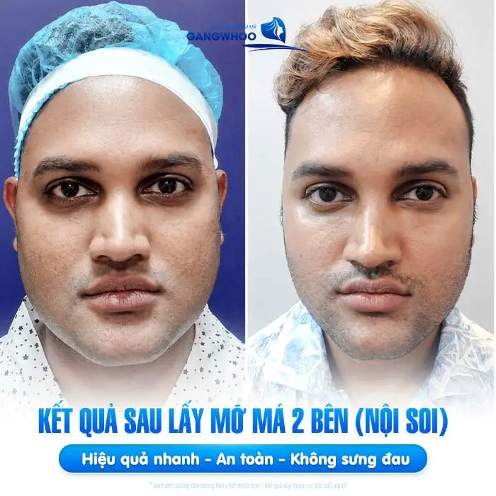 Kết quả lấy mỡ má 2 bên (nội soi) hiệu quả nhanh - an toàn và không sưng đau