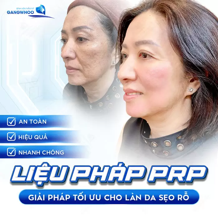 Điều Trị Sẹo Rỗ Bằng Máu Tự Thân "Hết Rỗ 99%" 4 Xóa sẹo rỗ PRP giải pháp tối ưu cho làn da bị tình trạng sẹo rỗ