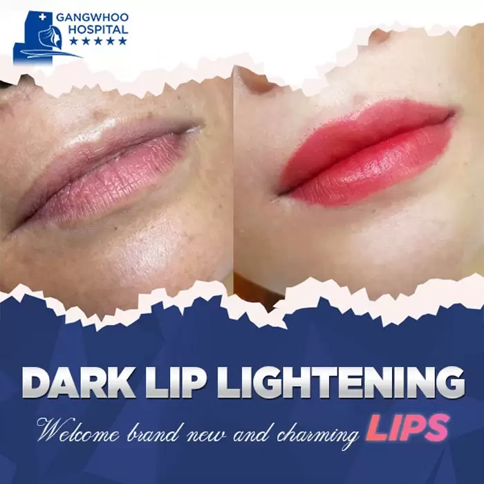 Dark Lip Lightening for Men & Women 1 lip lightening 1