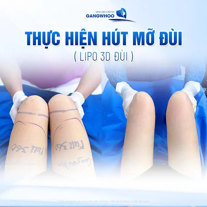 Hút mỡ vùng đùi Lipo 3D đùi loại bỏ mỡ thừa đùi thon gọn, săn chắc hài hòa tự tin hơn với đôi chân thon đẹp