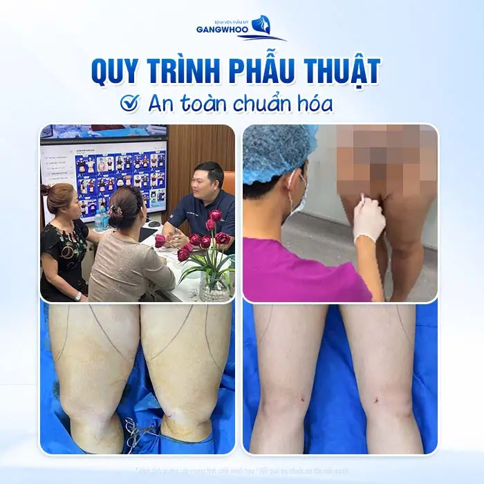 Hút mỡ vùng đùi Lipo 3D đùi loại bỏ mỡ thừa đùi thon gọn, săn chắc hài hòa tự tin hơn với đôi chân thon đẹp
