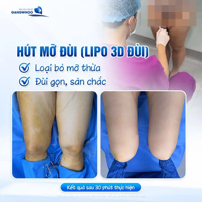 Hút mỡ vùng đùi Lipo 3D đùi loại bỏ mỡ thừa đùi thon gọn, săn chắc hài hòa tự tin hơn với đôi chân thon đẹp