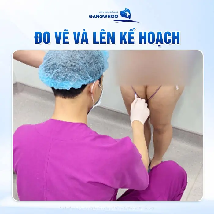 Hút mỡ vùng đùi Lipo 3D đùi loại bỏ mỡ thừa đùi thon gọn, săn chắc hài hòa tự tin hơn với đôi chân thon đẹp