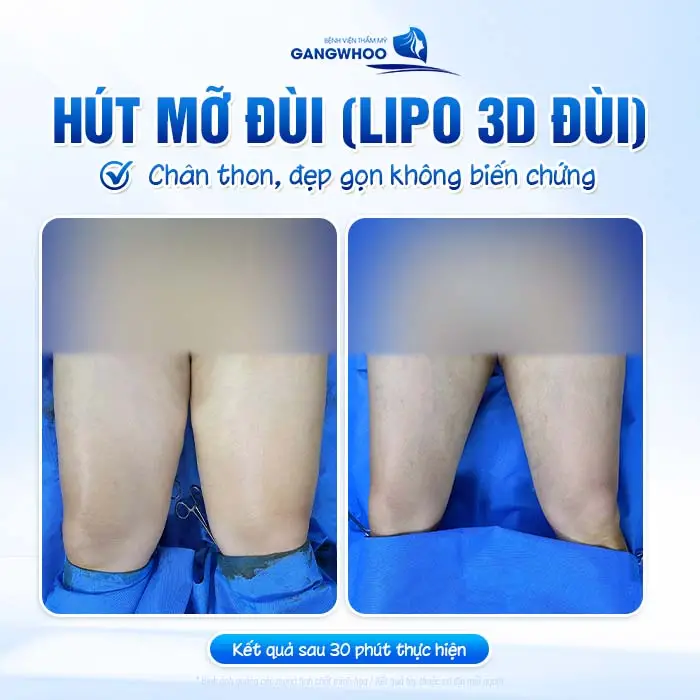 Phẫu Thuật Hút Mỡ Đùi (Lipo 3D Đùi) Tự Tin Diện Váy Ngắn Khoe Đôi Chân "Nuột Nà"