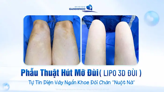 lipo 3d dui