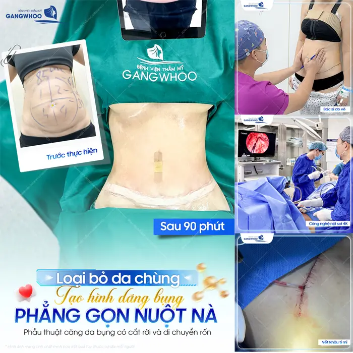 Cắt Da Thừa Bụng Và Tạo Eo Thon Cho Dáng Thon Thả "Nuột Nà" 4 Loại bỏ da chùng tạo hình thành bụng gọn phẳng nuột tự tin khoe sắc nuột nà