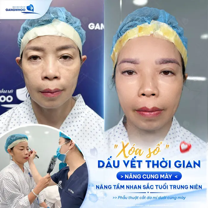 Phẫu Thuật Treo Cung Mày Trực Tiếp Nội Soi (Nâng Cung Chân Mày) Thổi Bay Dấu Hiệu "Lão Hóa" 1 Xóa sổ dấu vết thời gian nâng cung chân mày nâng tầm nhan sắc ở tuổi trung niên