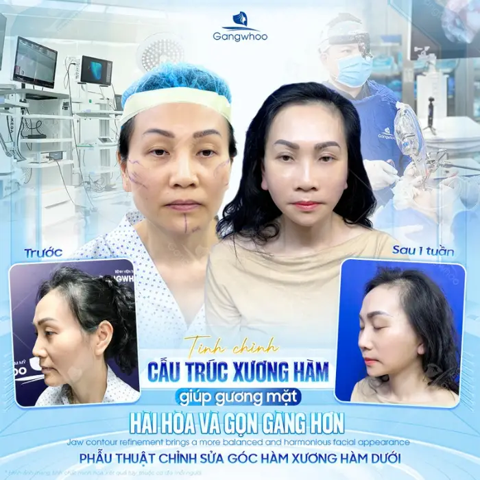 Advanced V-Line Mandible Trim in Vietnam – Sculpt a Slim Jawline 2 mandible v line trim provides a slimmer jawline