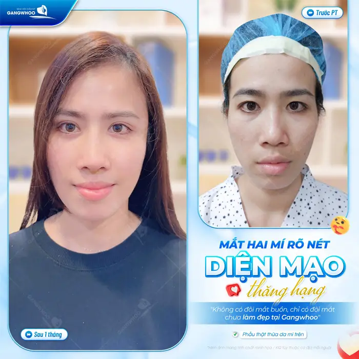 Mắt 2 mí diện mạo rõ nét đẹp thăng hạng và tràn đầy rạng rỡ