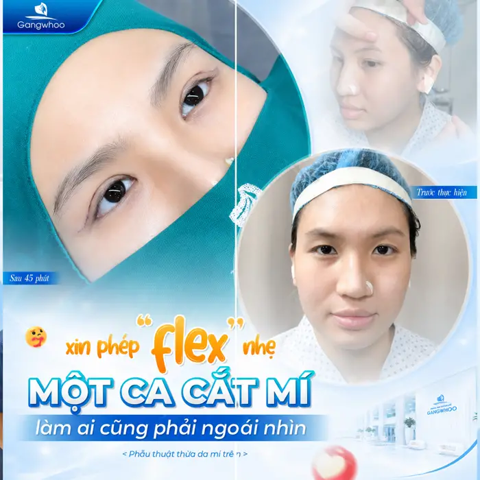 Kết quả sau cắt mí vừa hoàn thành đã đẹp xuất sắc và thu hút ánh nhìn như thế này đây