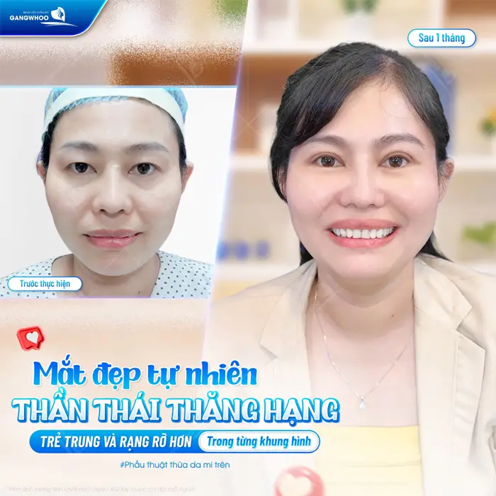 Cắt Mắt 2 Mí Có Để Lại Sẹo Không? Hướng Dẫn Chăm Sóc 1 Mắt đẹp tự nhiên thần thái thăng hạng trẻ trung và rạng rỡ hơn trong từng khung hình