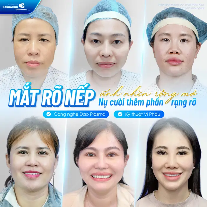 Mắt rõ nếp ánh nhìn mở rộng nụ cười thêm rạng rỡ với công nghệ kỹ thuật hiện đại 