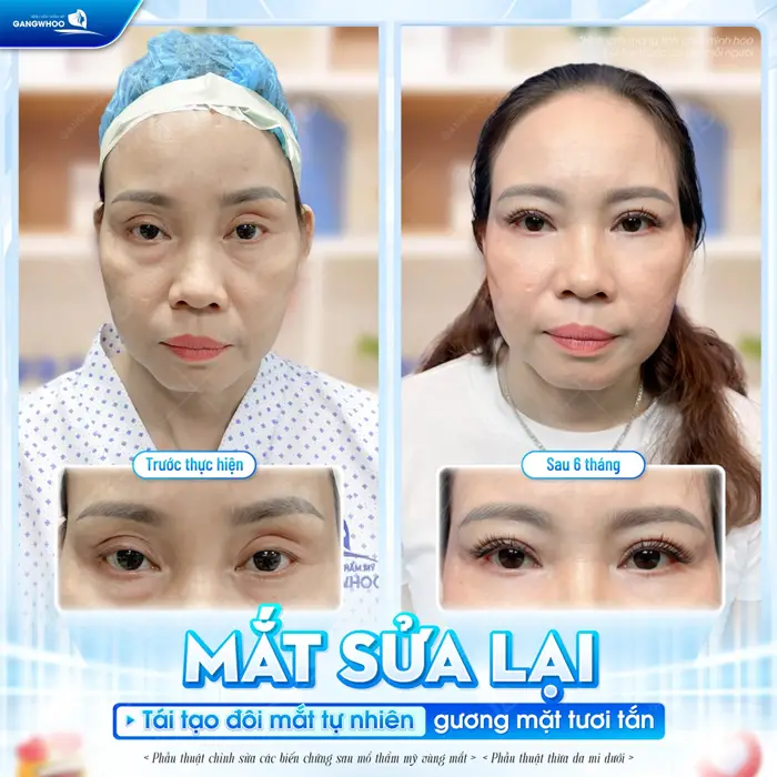 Mắt sửa lại tái tạo đôi mắt tự nhiên với gương mặt thêm tươi tắn và rạng rỡ