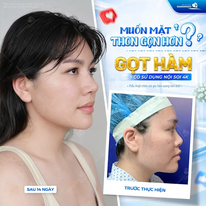 Gọt Hàm Có Để Lại Di Chứng Không? Cách Chăm Sóc Nhanh Lành 9 Gọt hàm có sử dụng nội soi 4K mặt thon gọn, thêm hài hòa với đường viền hàm thêm sắc nét