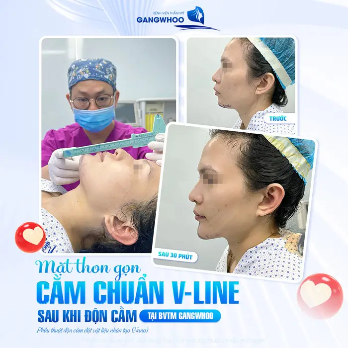 Mặt thon gọn cằm đẹp chuẩn V Line sau khi độn cằm tại BVTM Gangwhoo