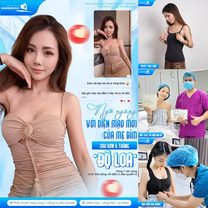 Sắc vóc thăng hạng diện mạo mới đầy cuốn hút sau phẫu thuật nâng cấp vòng 1 bằng túi độn 