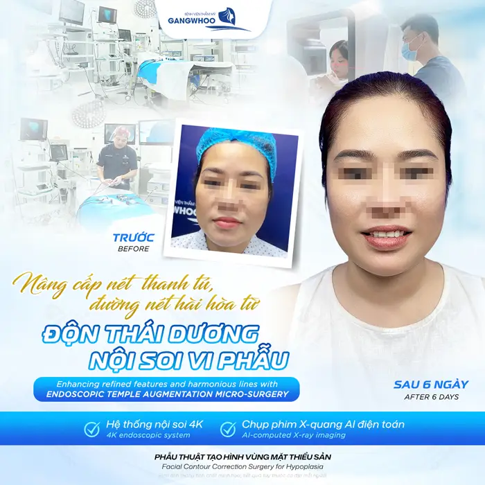 Phẫu thuật tạo hình vùng mặt thiểu sản nâng cấp nét đẹp thanh tú, đường nét thêm hài hòa cuốn hút