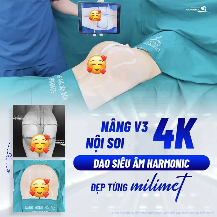 Nâng Mông Nội Soi "Tôn Vinh Vòng 3 Căng Tròn Quyến Rũ" 2 Nâng vòng 3 nội soi 4K kết hợp với dao Harmonic đẹp từng milimet