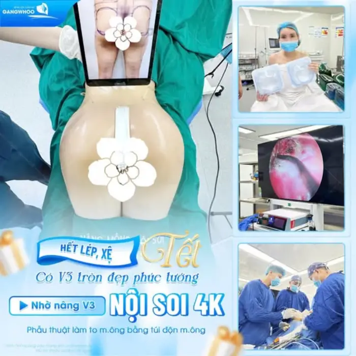 Cận cảnh kết quả nâng mông nội soi 4K kết hợp túi độn chuyên biệt - Đường cong quyến rũ, phục hồi nhanh