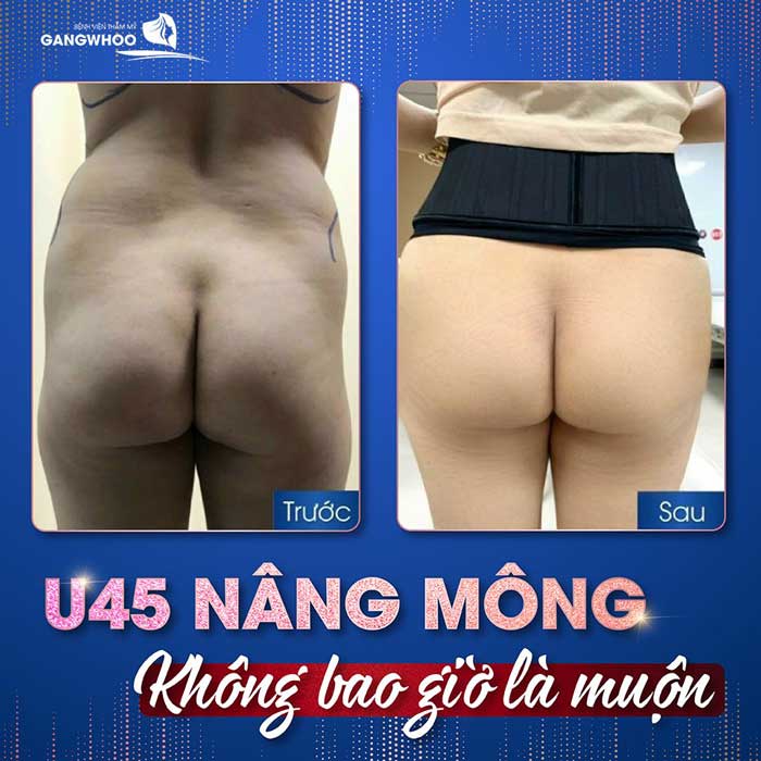 Images of our customers before & after buttock augmentation at Gangwhoo Cosmetic Hospital