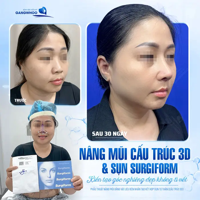 Sau 30 ngày phẫu thuật nâng mũi cấu trúc 3D và sụn Surgiform kiến tạo góc nghiêng đẹp không tì vết