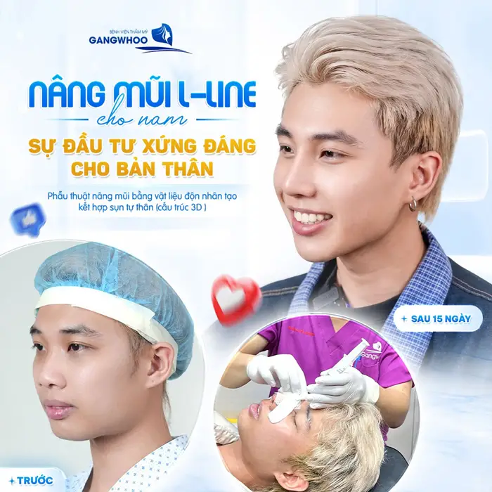 Nâng mũi L Line cho nam sự đầu tư xứng đáng cho diện mạo thêm bừng sáng và tự tin 
