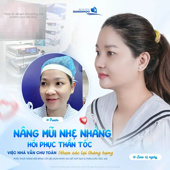 Nâng mũi nhẹ nhàng hồi phục thần tốc việc nhà vẫn chu toàn mà nhan sắc vẫn thăng hạng rõ rệt chỉ sau 15 ngày
