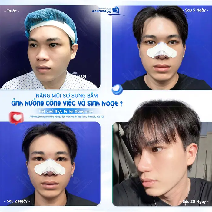Nâng mũi sợ sưng bầm ảnh hưởng tới công việc và sinh hoạt kết quả thực tế nhanh lành và nhanh hồi phục