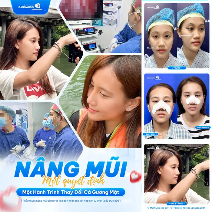 Nâng mũi 1 quyết định mở ra 1 hành trình thay đổi cả gương mặt với góc nghiêng đẹp xuất sắc
