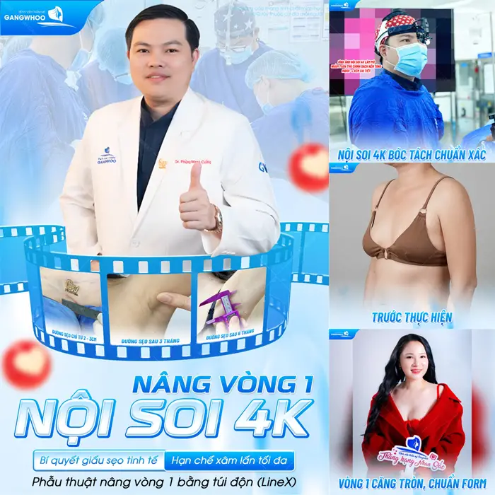 Nâng vòng 1 nội soi bí quyết giấu sẹo tinh thế hạn chế tối đa xâm lấn 
