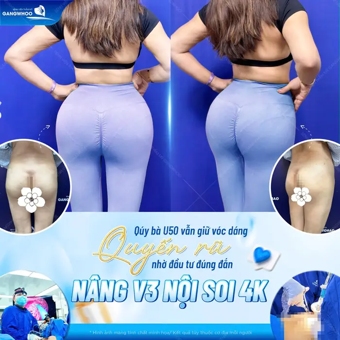 Nâng Mông Nội Soi "Tôn Vinh Vòng 3 Căng Tròn Quyến Rũ" 4 Nâng vòng 3 nội soi 4K vóc dáng quyến rũ, mềm mại đẹp siêu thực