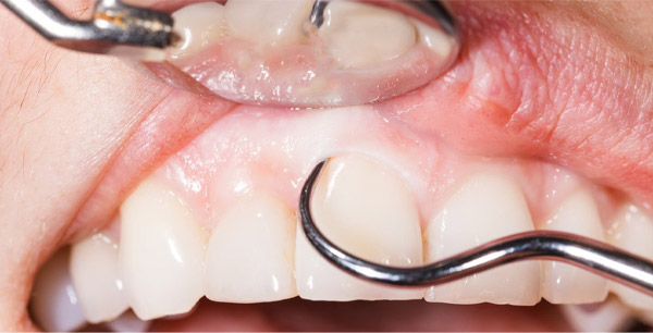 Nạo túi nha chu quanh răng để ngăn ngừa các bênh lý răng miệng