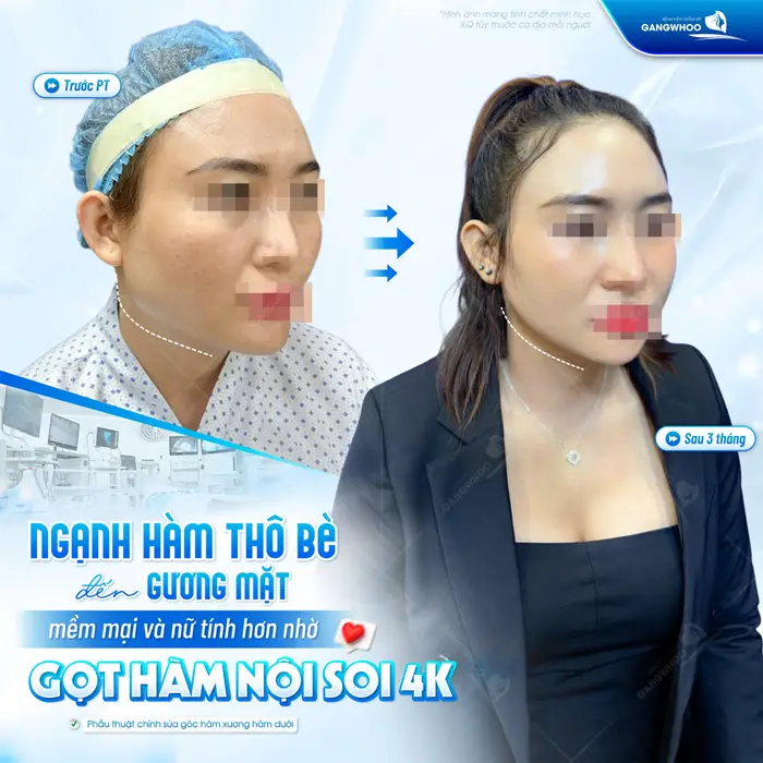 Từ ngạnh hàm thô bè đến gương mặt mềm mại và nữ tính hơn nhờ gọt hàm nội soi 4K
