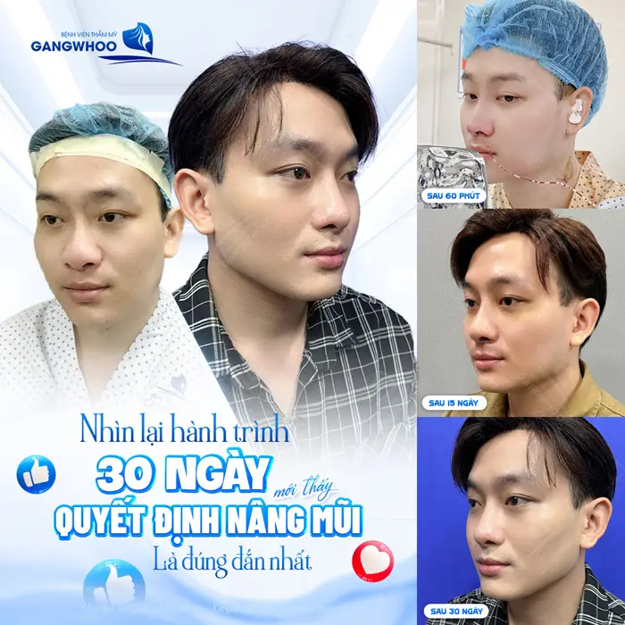 Nhìn lại hành trình 30 ngày nâng mũi tự tin hơn với một phiên bản mới