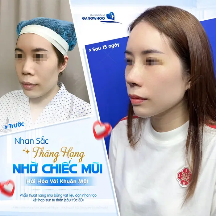 Nhan sắc thăng hạng nhờ chiếc mũi cao thon hài hòa, đẹp chuẩn tỷ lệ với gương mặt