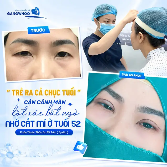 Trẻ ra chục tuổi cận cảnh màn lột xác bất ngờ nhờ cắt mí ở tuổi 52