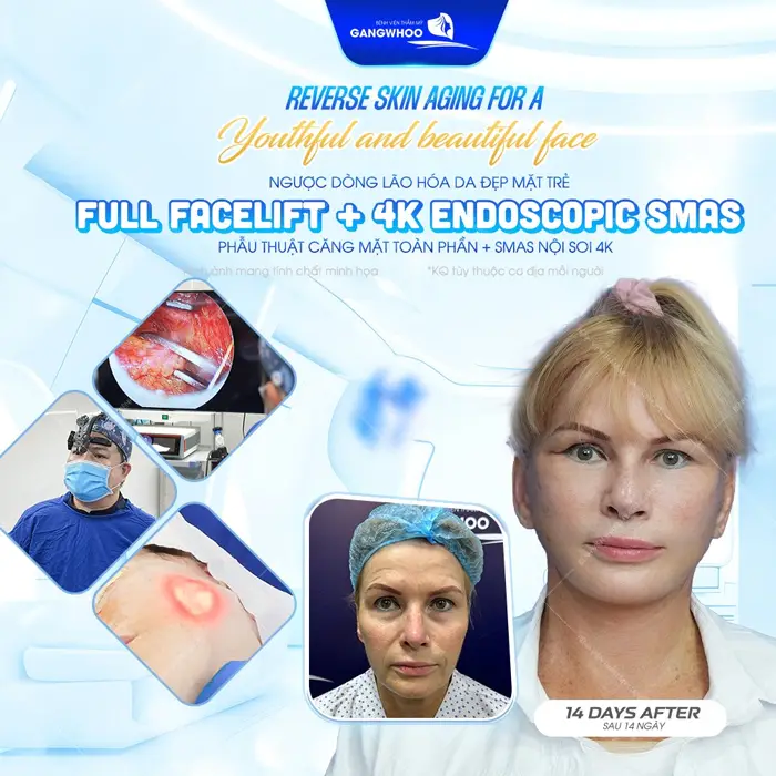 Căng Da Mặt Nội Soi Ở Đâu? 7 Địa Chỉ Uy Tín Tại TPHCM 16 Phẫu thuật căng da mặt toàn phần Smas nội soi 4K bí quyết trẻ hóa dài lâu được khách hàng lựa chọn