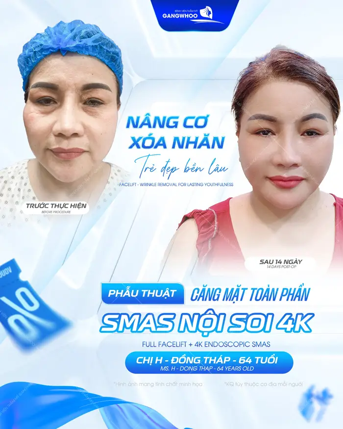 Căng Da Mặt Nội Soi Ở Đâu? 7 Địa Chỉ Uy Tín Tại TPHCM 1 Phẫu thuật căng da mặt toàn phần xóa nhăn nâng cơ, gương mặt trẻ đẹp diện mạo trẻ trung