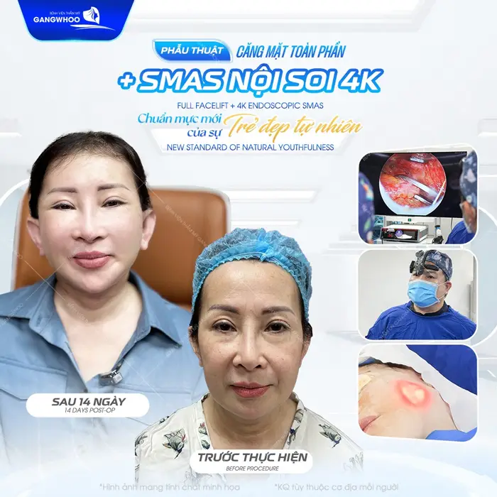 Căng Da Mặt Nội Soi Ở Đâu? 7 Địa Chỉ Uy Tín Tại TPHCM 13 Phẫu thuật căng da mặt toàn phần chuẩn mực mới của làn da trẻ đẹp dài lâu