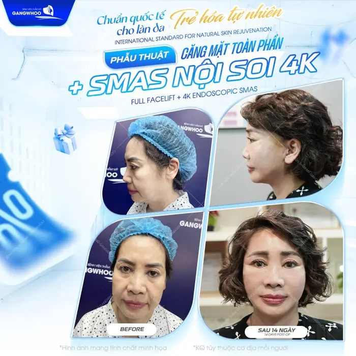 Căng Da Mặt Nội Soi Ở Đâu? 7 Địa Chỉ Uy Tín Tại TPHCM 15 Phẫu thuật căng da mặt toàn phần trẻ hóa làn da đẹp lâu dài với hiệu quả cải thiện rõ rệt sau 14 ngày