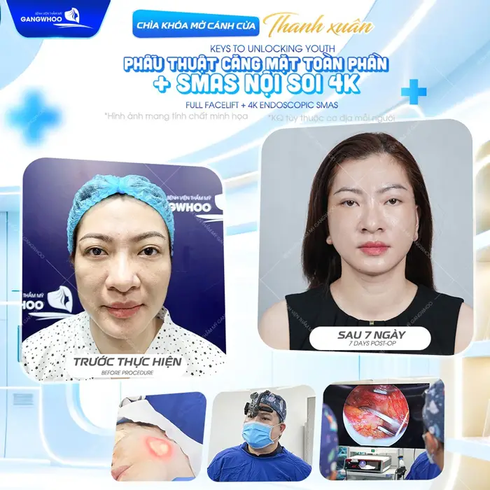 Căng Da Mặt Nội Soi Ở Đâu? 7 Địa Chỉ Uy Tín Tại TPHCM 2 Phẫu thuật căng d ămtj toàn phần cải thiện diện mạo nâng tầm tự tin chỉ sau 7 ngày