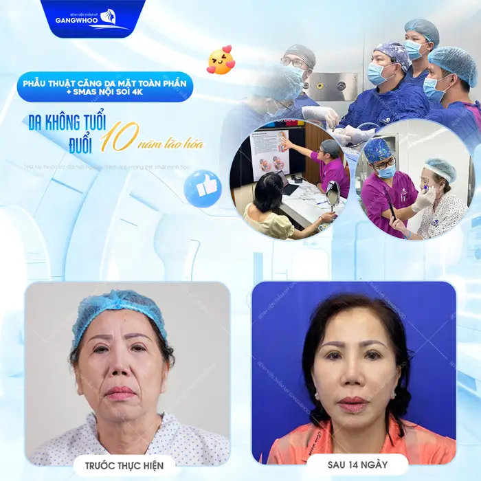 Phẫu thuật căng da mặt Smas nội soi 4K da trẻ hơn, đẹp hơn sau 10 năm đã trẻ đẹp xuất sắc