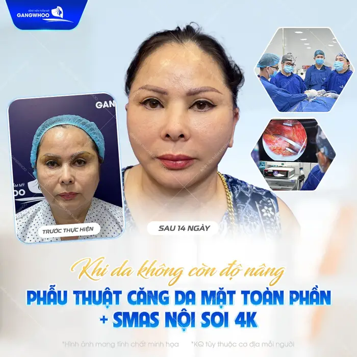 Phẫu thuật căng da mặt toàn phần Smas nội soi 4K sau 14 ngày làn da trẻ đẹp rạng rỡ đến bất ngờ