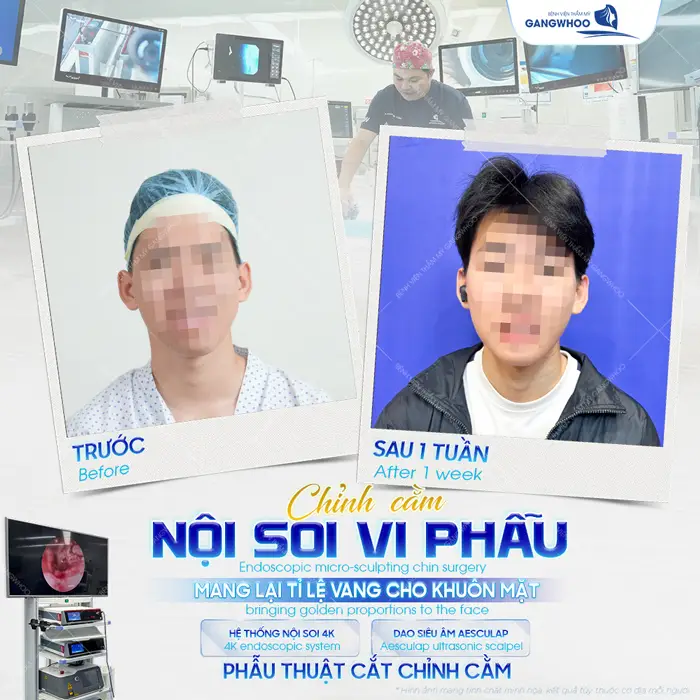 Chỉnh cằm nội soi vi phẫu mang lại tỷ lệ vàng cho khuôn mặt an toàn và hiệu quả cao