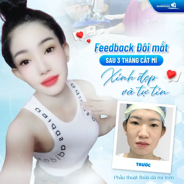 Phẫu thuật thừa da mi trên toát ánh nhìn xinh đẹp và tự tin sau 3 tháng thực hiện