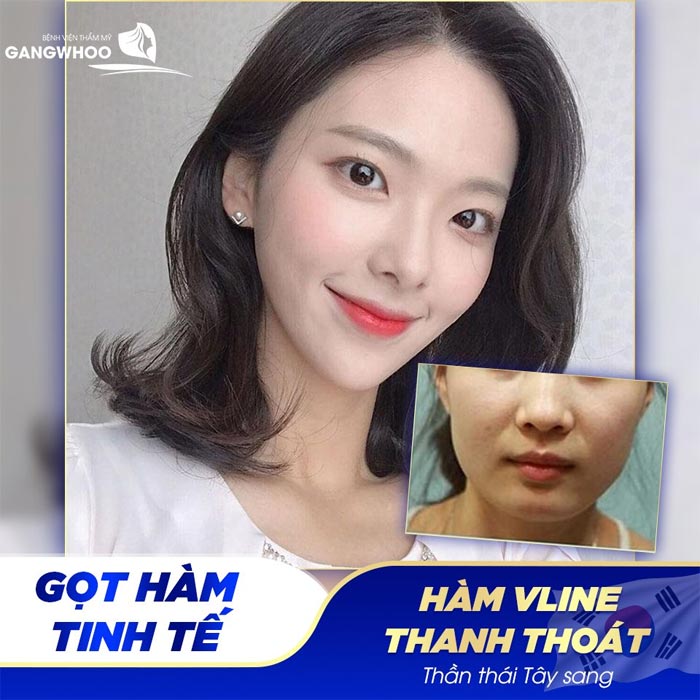 Phẫu Thuật Hàm Hô Và Trượt Cằm Tạo Hình Gương Mặt Thanh Tú 13 Sở hữu khuôn mặt tinh tế nhờ phẫu thuật hàm hô và trượt cằm