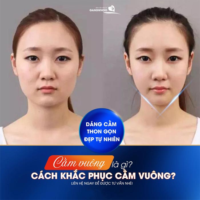 Phẫu Thuật Hàm Hô Và Trượt Cằm Tạo Hình Gương Mặt Thanh Tú 11 Khuôn mặt V line duyên dáng