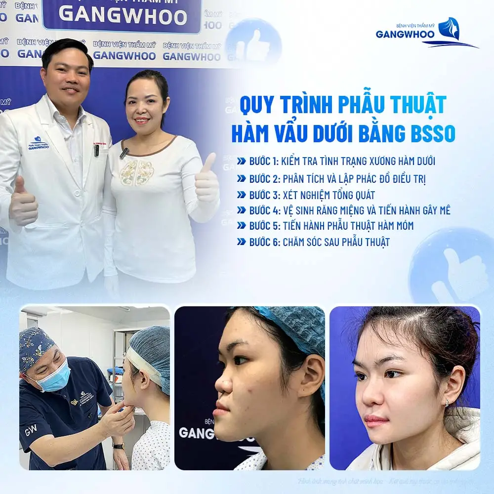 Quy trình phẫu thuật hàm vẩu dưới bằng BSSO an toàn và chuẩn hóa từng bước